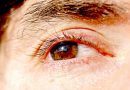 Ojo seco: ¿Molestia temporal o una amenaza para la vista?